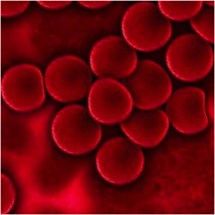 Mielodisplasie, quando il sangue si impoverisce