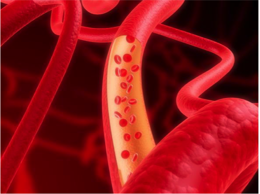 Sindromi mielodisplastiche, tipiche degli anziani e poco conosciute: sapete cosa sono?